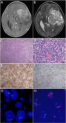 Case Report: A Unique Case of Pediatric Central Nervous System Embryonal Tumor Harboring the CIC–LEUTX Fusion, Germline NBN Variant and Somatic TSC2 Mutation: Expanding the Spectrum of CIC-Rearranged Neoplasia